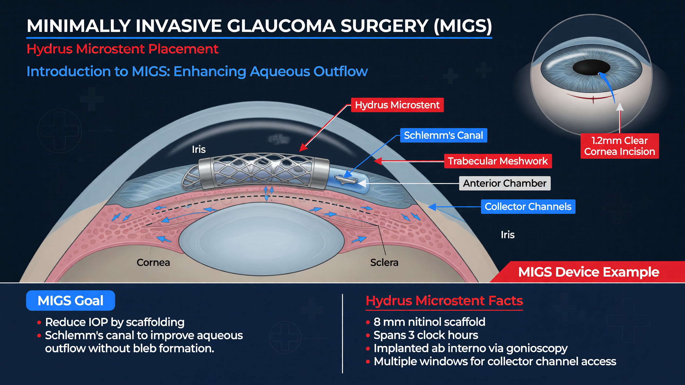 Diagram showing placement of a MIGS device such as the Hydrus Microstent.