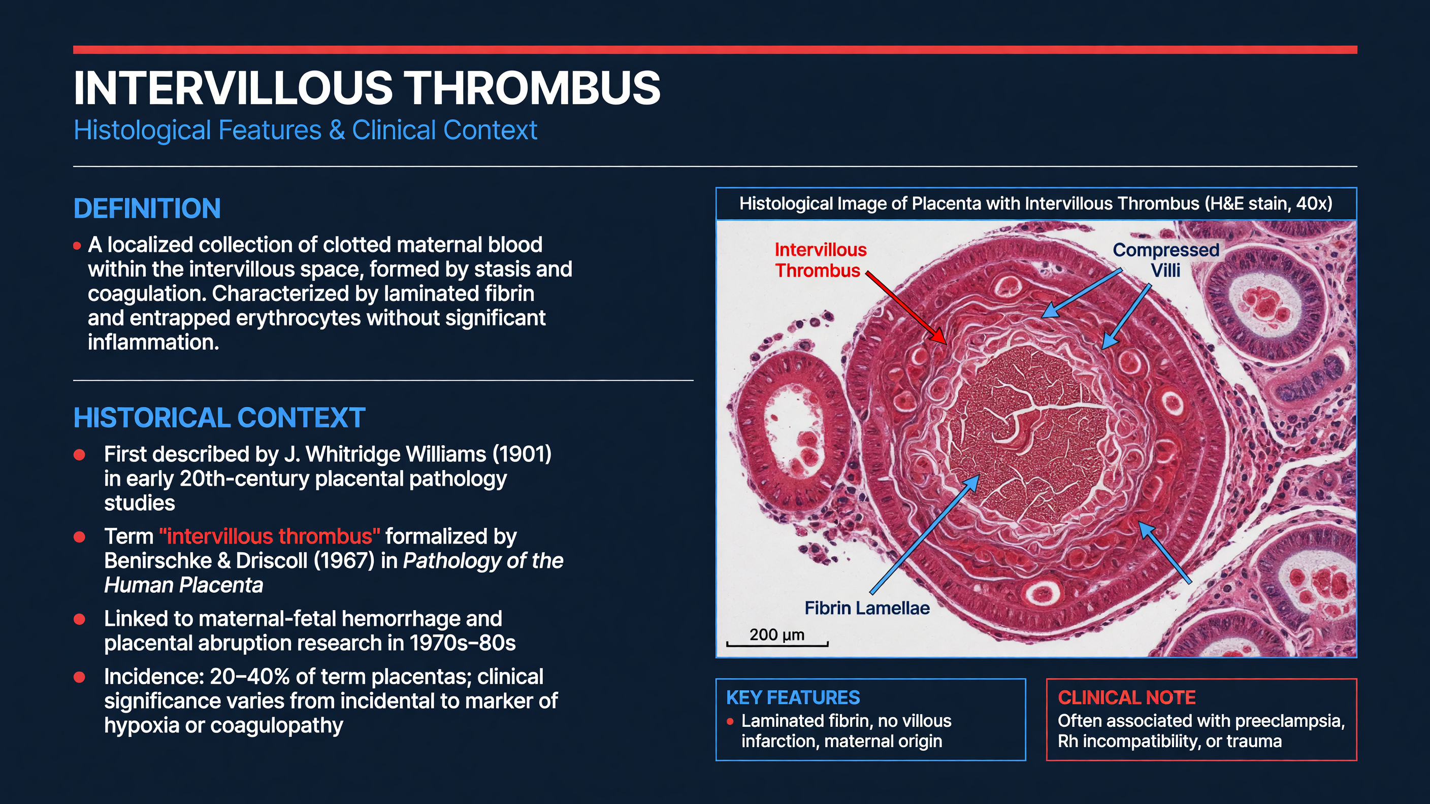 Histological image of placenta showing intervillous thrombus