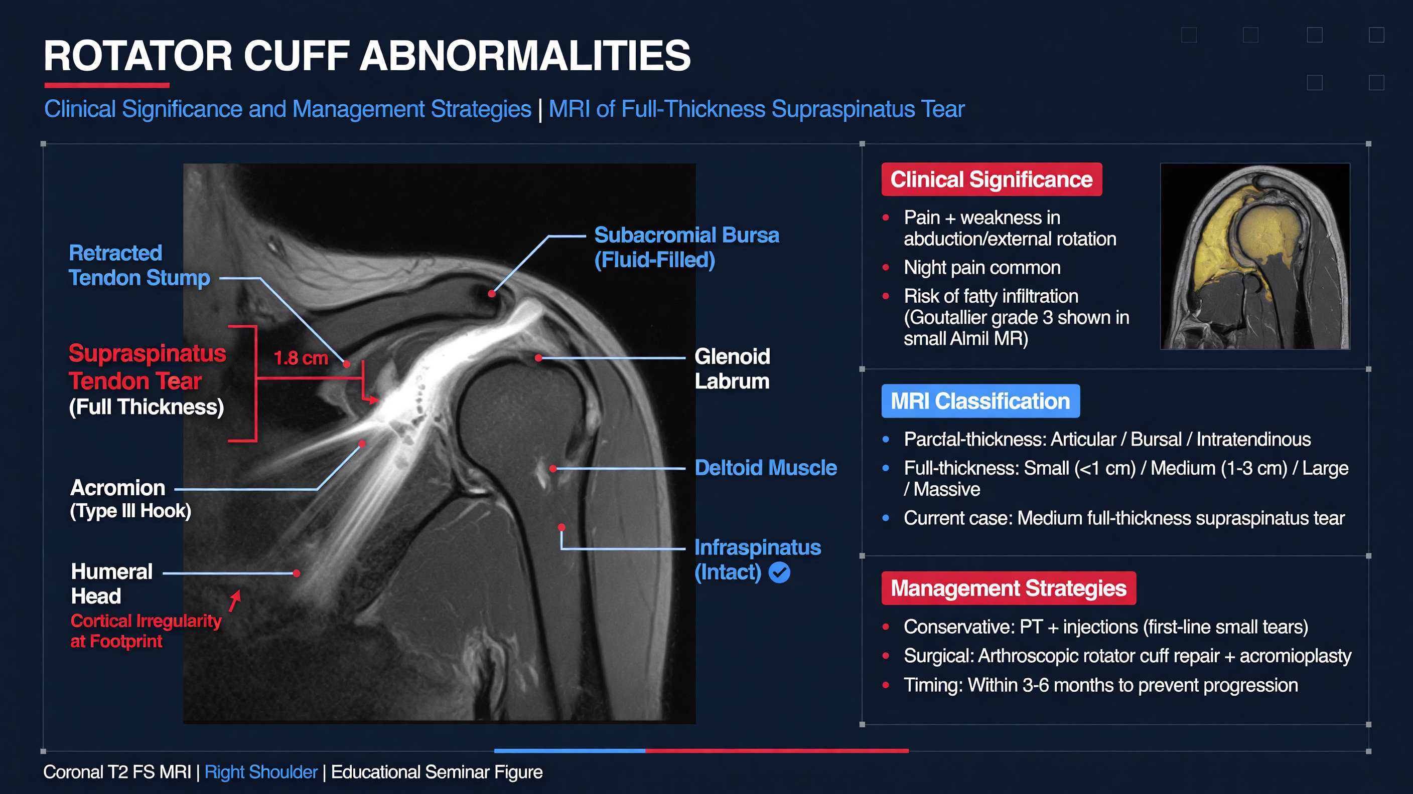 MRI of a rotator cuff tear with labeled anatomical structures